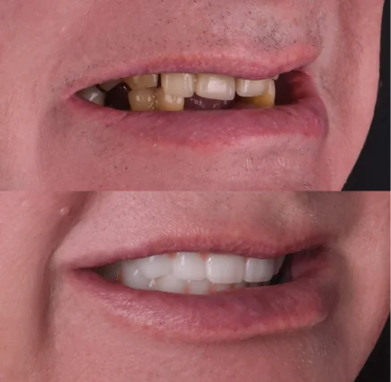 Before and after comparison of a dental patient: the 'before' image shows missing teeth and discolored enamel, while the 'after' image displays a restored, uniform, and radiant smile.
