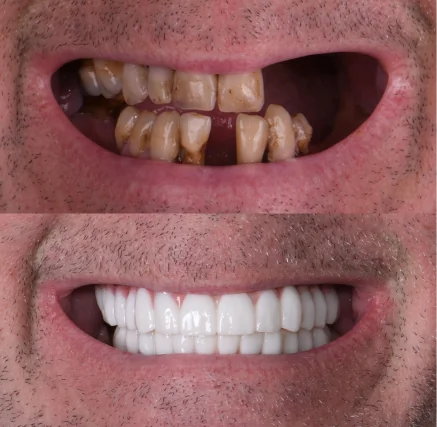 Before and after dental restoration: the 'before' image shows significant tooth wear, decay, and gaps. The 'after' image features a complete, bright, and perfectly aligned full-arch reconstruction.