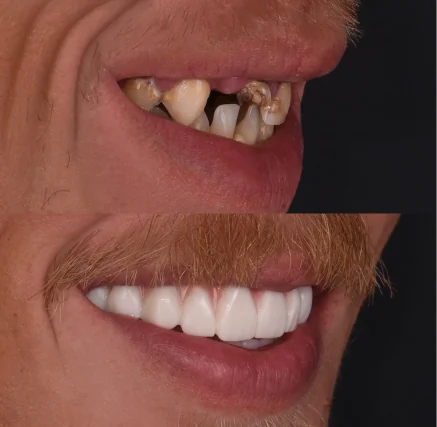 Side-by-side comparison of a dental smile makeover: the 'before' photo reveals damaged and missing teeth; the 'after' photo shows a healthy, natural-looking, and confident smile restoration.