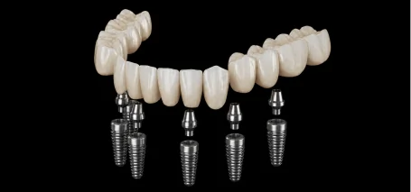 Dental restoration illustration showing a bridge supported by implants