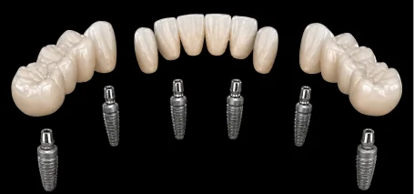 Dental restoration illustration showing six implants and a 3-unit bridge