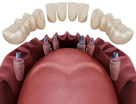 Medical illustration of a 3-on-6 dental implant procedure. Six titanium dental implants are embedded into the lower jawbone, each topped with an abutment. Floating above the gum line are three dental bridges—one central set of incisors and two posterior sections—designed to be attached to the six implants to restore the full dental arch.