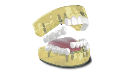 Dental model demonstrating implant-supported crowns for a 3-on-6 restoration.