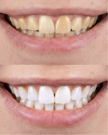 Close-up before and after results of a professional teeth whitening treatment. Stained teeth are transformed into a bright, white smile.