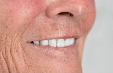 A close-up view of a natural, healthy smile, illustrating the successful outcome during the recovery phase of the 3-on-6 dental implant process.