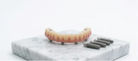All-on-4 dental implant prosthesis featuring a full upper arch supported by four strategically placed implants.