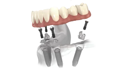 All-on-4 dental implant illustration with implant-supported full-arch prosthesis.