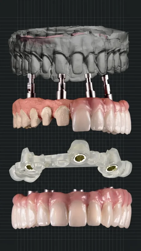 Step-by-step illustration of the All-on-4 dental implant process from implant placement to final restoration.