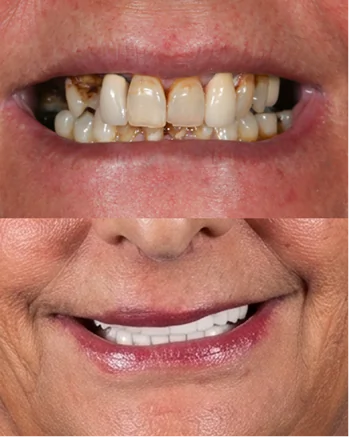 Before and after of a full mouth reconstruction. Shows missing and decayed teeth replaced with permanent All-on-4 dental implants.