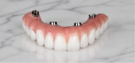 Full-arch dental bridge designed to be anchored by four strategically placed implants.