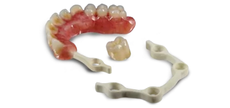 All-on-4 prosthetic arch with implant components designed for full-mouth restoration.