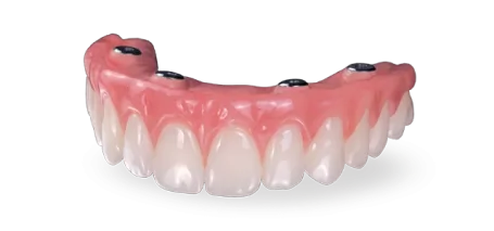 Full-arch All-on-4 dental prosthesis supported by implant-retained framework.