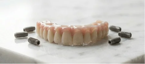 Full arch All-on-6 dental implant restoration supported by six titanium implants for enhanced stability.