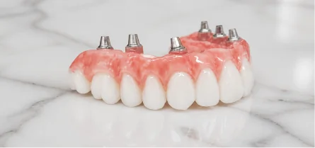 Full-arch dental bridge designed to be supported by a foundation of six dental implants for increased stability.