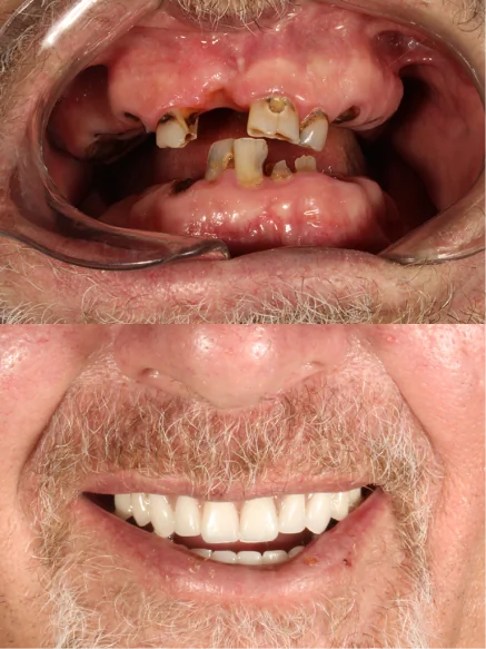 Before and after comparison showing dramatic smile improvement following dental implant treatment.