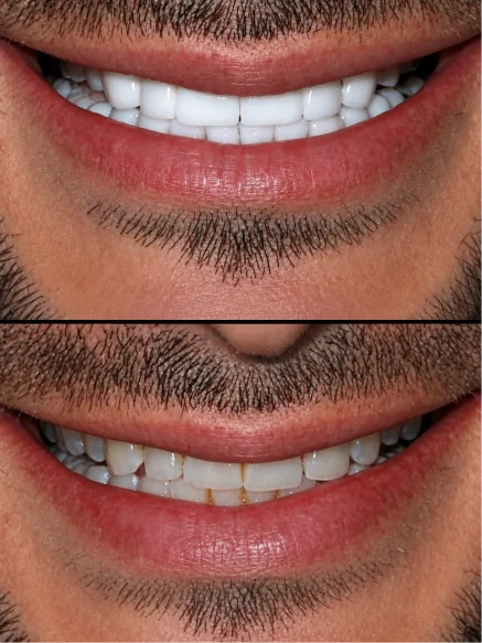 Before and after smile transformation with porcelain dental crowns at Smile Makeover Playa del Carmen.