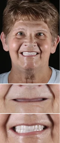Before and after dental implant transformation showing significant improvement in smile appearance and tooth restoration.