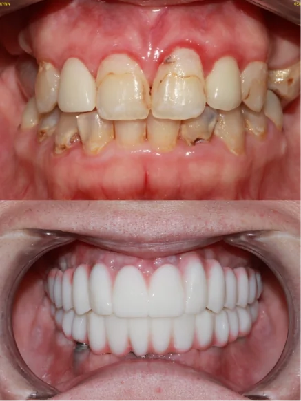 Dental implant transformation displaying restored teeth and enhanced smile aesthetics
