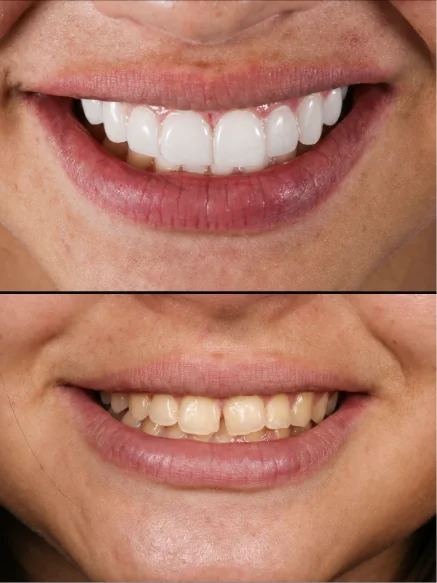 Patient smile before and after receiving cosmetic dental crowns in Mexico.