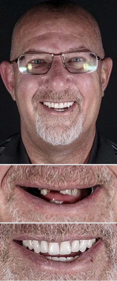Dental implant smile makeover comparison highlighting restored teeth and improved oral aesthetics.