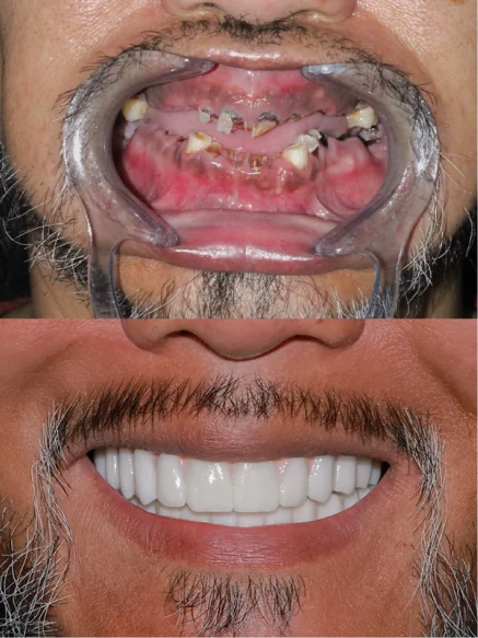 Full-mouth restoration before and after images highlighting succesful implant-supported smile rehabilitation.