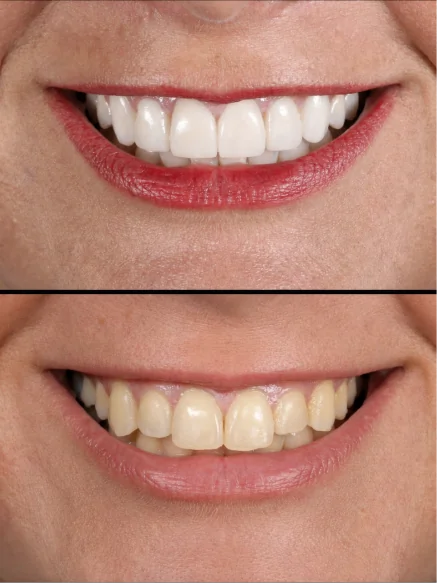 Dental crowns before and after results showing improved tooth color and alignment.