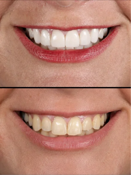 Veneers before and after comparison highlighting improved tooth shape, color, and symmetry.
