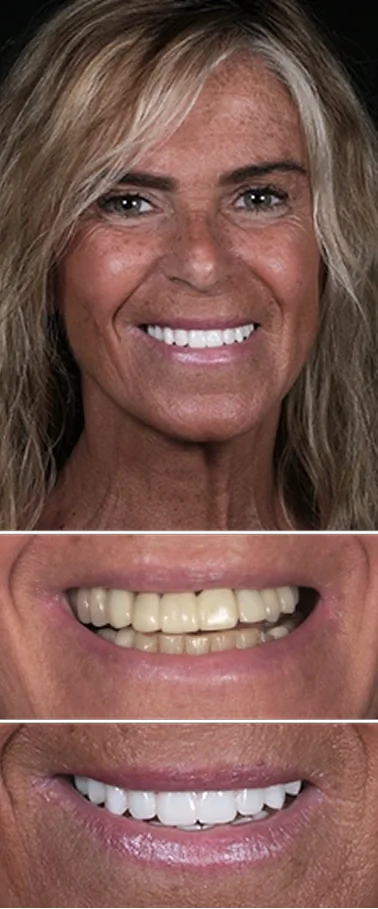 Collection of dental implant patients displaying successful smile transformations before and after treatment.