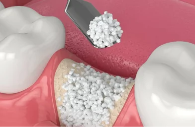 Bone graft illustration used to prepare the jaw for dental implant placement.