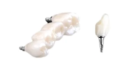 Implant-supported dental bridge prosthesis displayed with implant hardware for tooth replacement treatment.