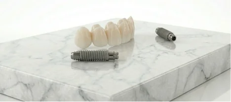 Close-up view of a titanium dental implant screw used to replace a missing tooth root.