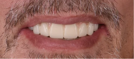 Natural-looking smile restored with high-quality dental crowns at Smile Makeover Playa del Carmen.