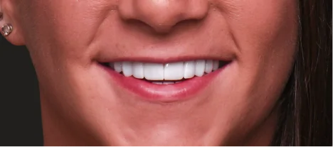 Patient smile after affordable dental crowns treatment in Mexico.