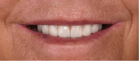 Cosmetic dental crowns creating a bright and symmetrical smile.