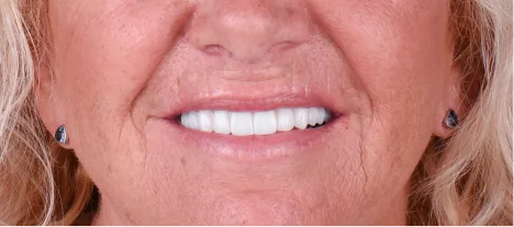 Dental crowns results showing improved aesthetics and function.