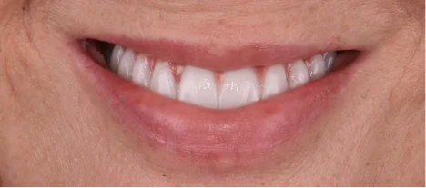 Smile makeover completed with custom-made porcelain crowns in Mexico.