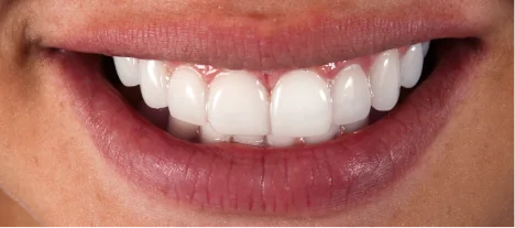 Close-up of healthy white smile restored with dental crowns in Mexico.