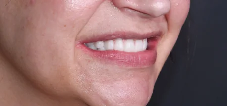 Patient smiling confidently after full cosmetic dental crowns treatment.