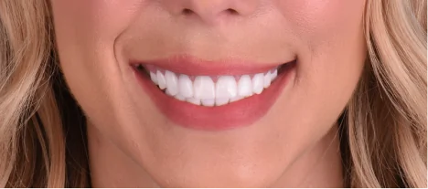 Beautiful smile after receiving custom porcelain dental crowns in Mexico.