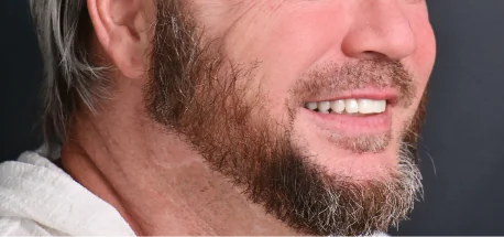 Before photo showing worn and damaged teeth prior to dental crowns restoration.