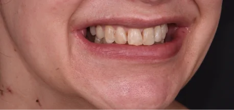 Patient smile before treatment with cosmetic dental crowns.