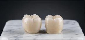 High-quality E.max ceramic dental crowns designed for natural aesthetics.
