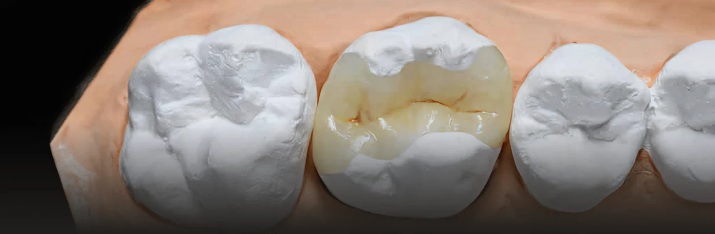 Custom ceramic inlays used to restore damaged teeth while preserving natural structure.