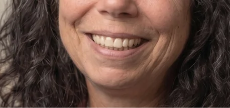 Close-up of patient's smile before cosmetic dentistry treatment.