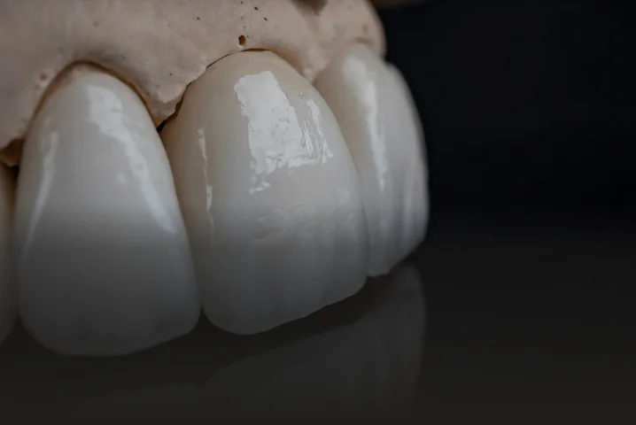 Close-up of porcelain dental crowns with a natural appearance and lifelike translucency.