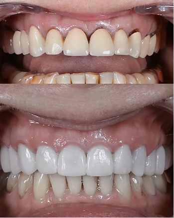 Before and after smile restoration replacing outdated dental work. Features natural-looking porcelain dental crowns with improved gum health.