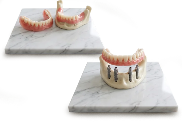 Comparison of traditional dentures and All-on-4 implant-supported restorations on display models.