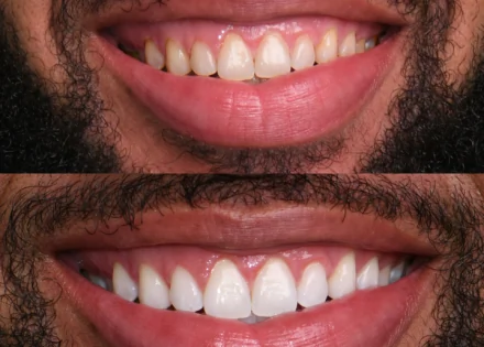 Before and after comparison of teeth whitening treatment showing a noticeable improvement in brightness and shade.