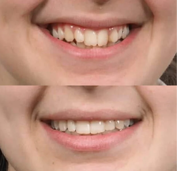 Before and after orthodontic treatment showing improved teeth alignment and a healthier smile.