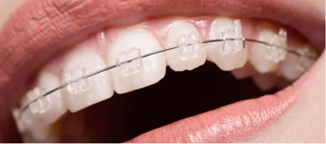 Ceramic braces providing a discreet and effective orthodontic solution for straighter teeth.